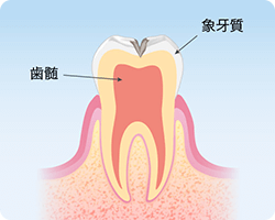 千葉市緑区高田町・たかだの森歯科・象牙質まで進んだむし歯（C2）