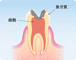 千葉市緑区高田町・たかだの森歯科・神経まで進んだむし歯(C3)