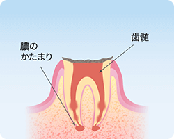 千葉市緑区高田町・たかだの森歯科・歯根だけ残ったむし歯(C4)