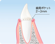千葉市緑区高田町・たかだの森歯科・歯肉炎