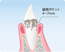 千葉市緑区高田町・たかだの森歯科・中等度歯周炎